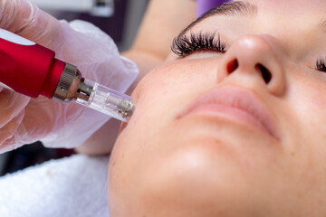 Microneedling